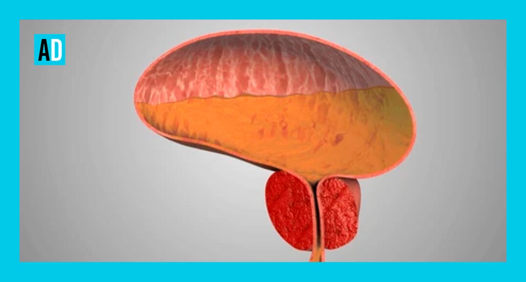 Geschwollene Prostata